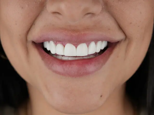 Después: corrección de color y forma con carillas E.max en Smile Dental Center Miami