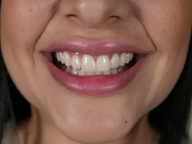 Antes: paciente con dientes de color y forma irregulares antes de carillas en Miami