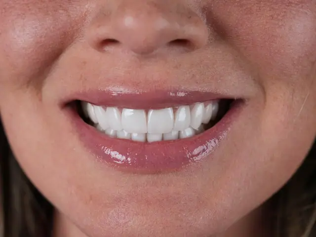 Después: la misma paciente con carillas de porcelana E.max en Smile Dental Center Miami