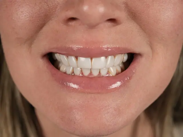 Antes: sonrisa de paciente antes de carillas de porcelana E.max en Miami
