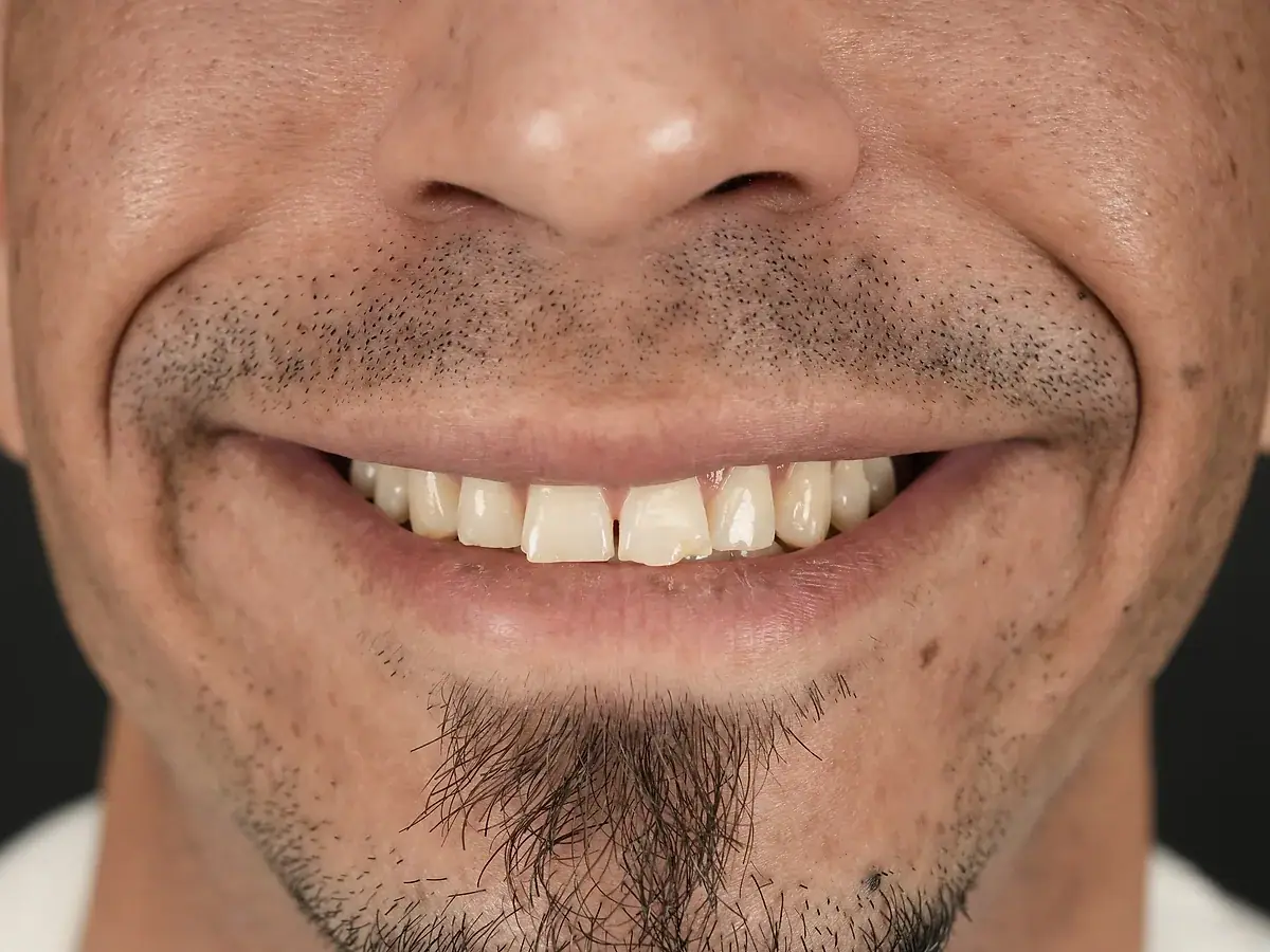 Before — Composite Veneers — Gap Closure