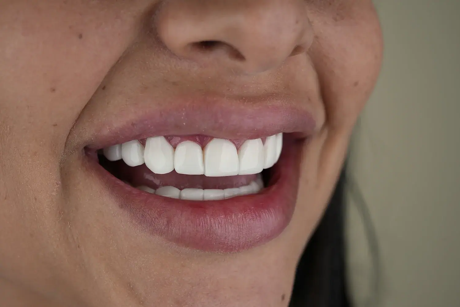 Sonrisa Brillante — Smile Dental Center