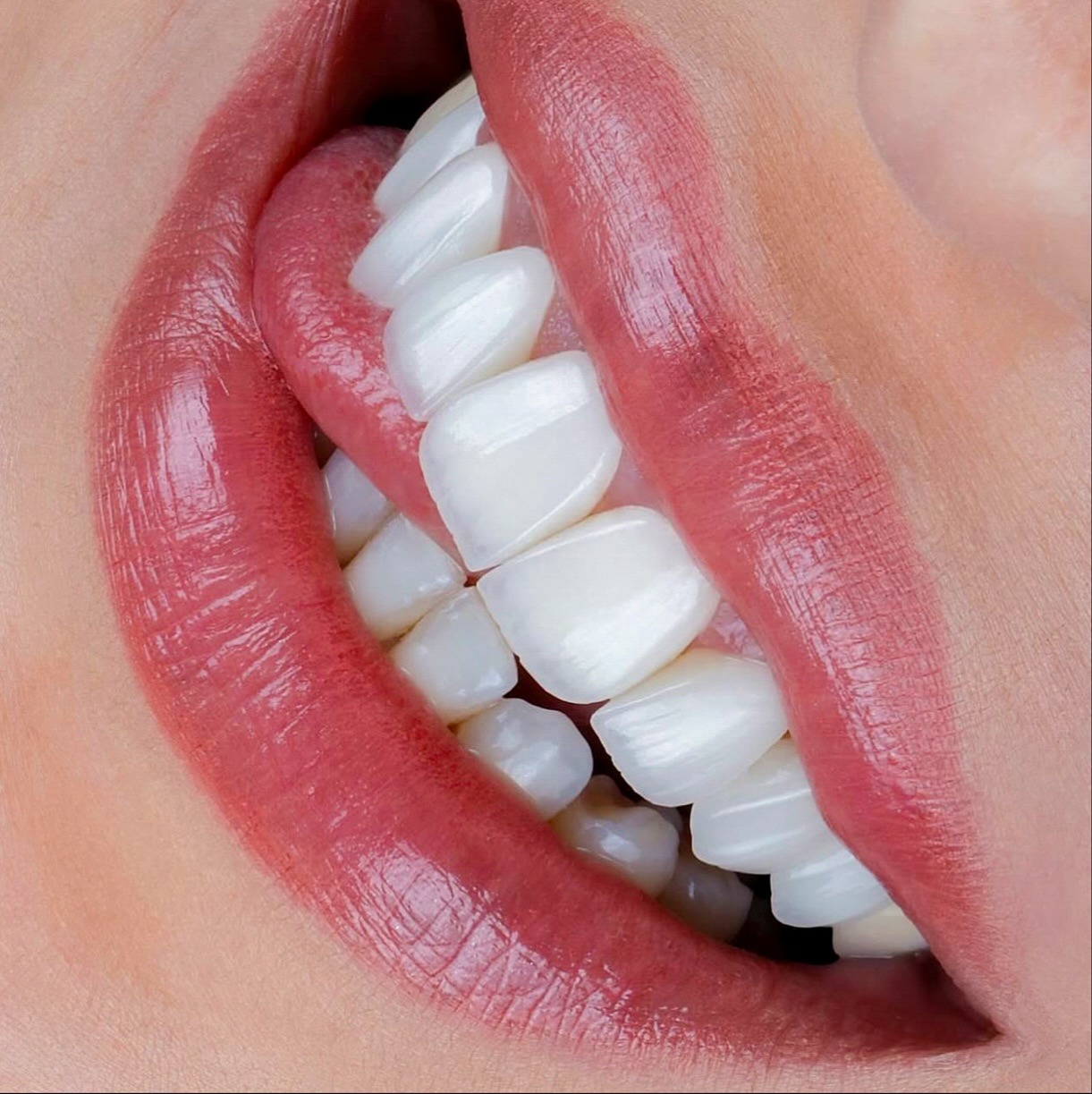 Before — Porcelain Veneers — Miami, FL