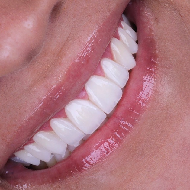 composite-veneers gallery 2