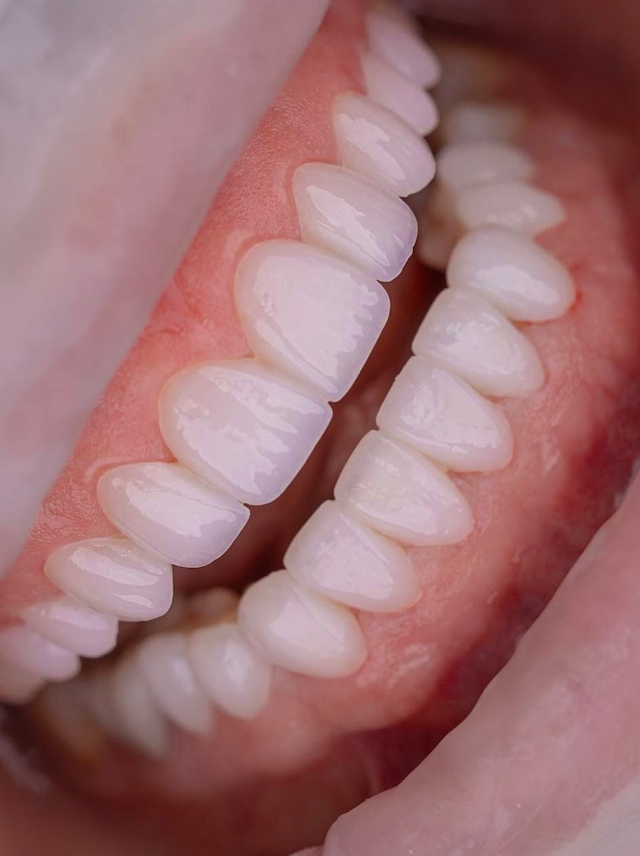 composite-veneers gallery 3