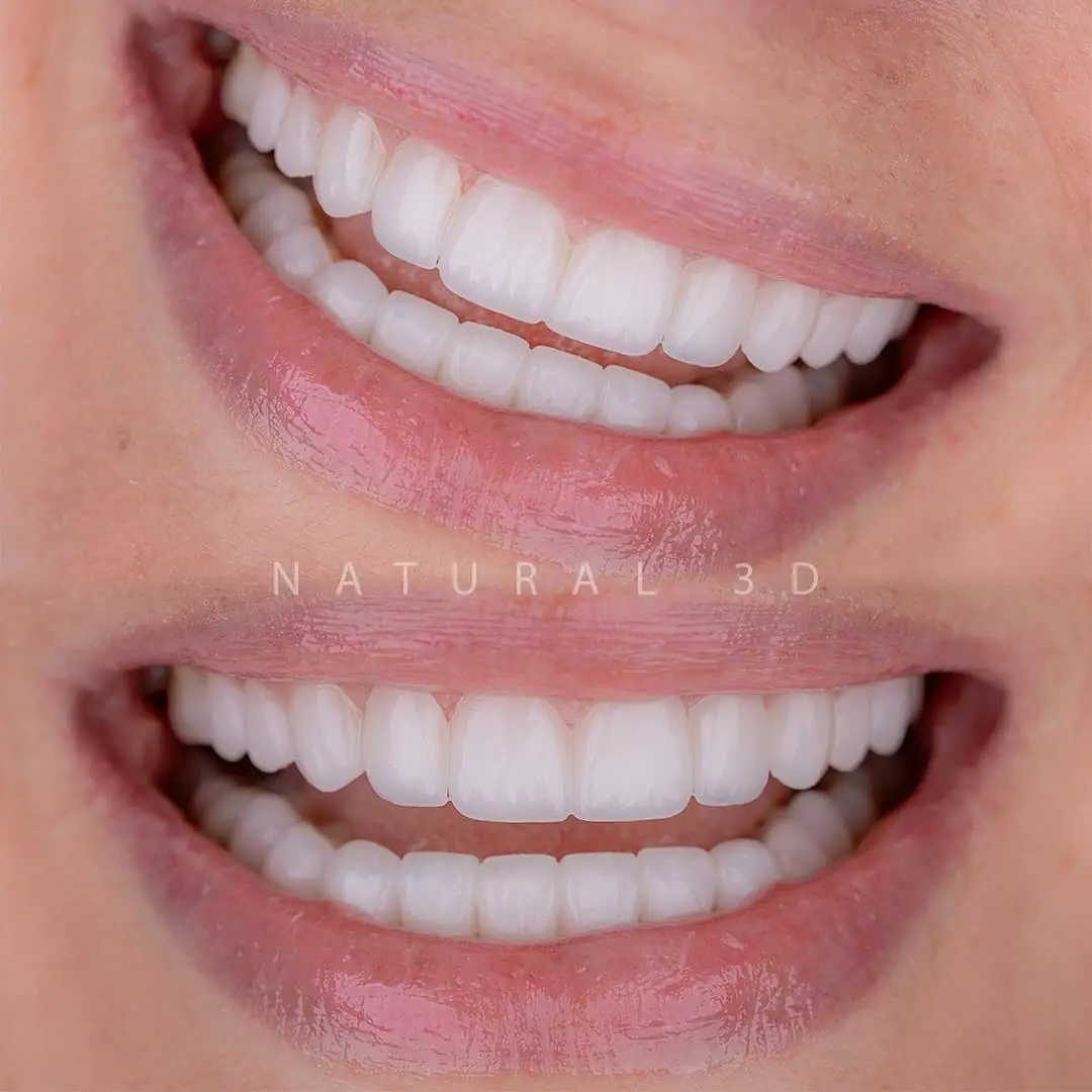 composite-veneers gallery 5