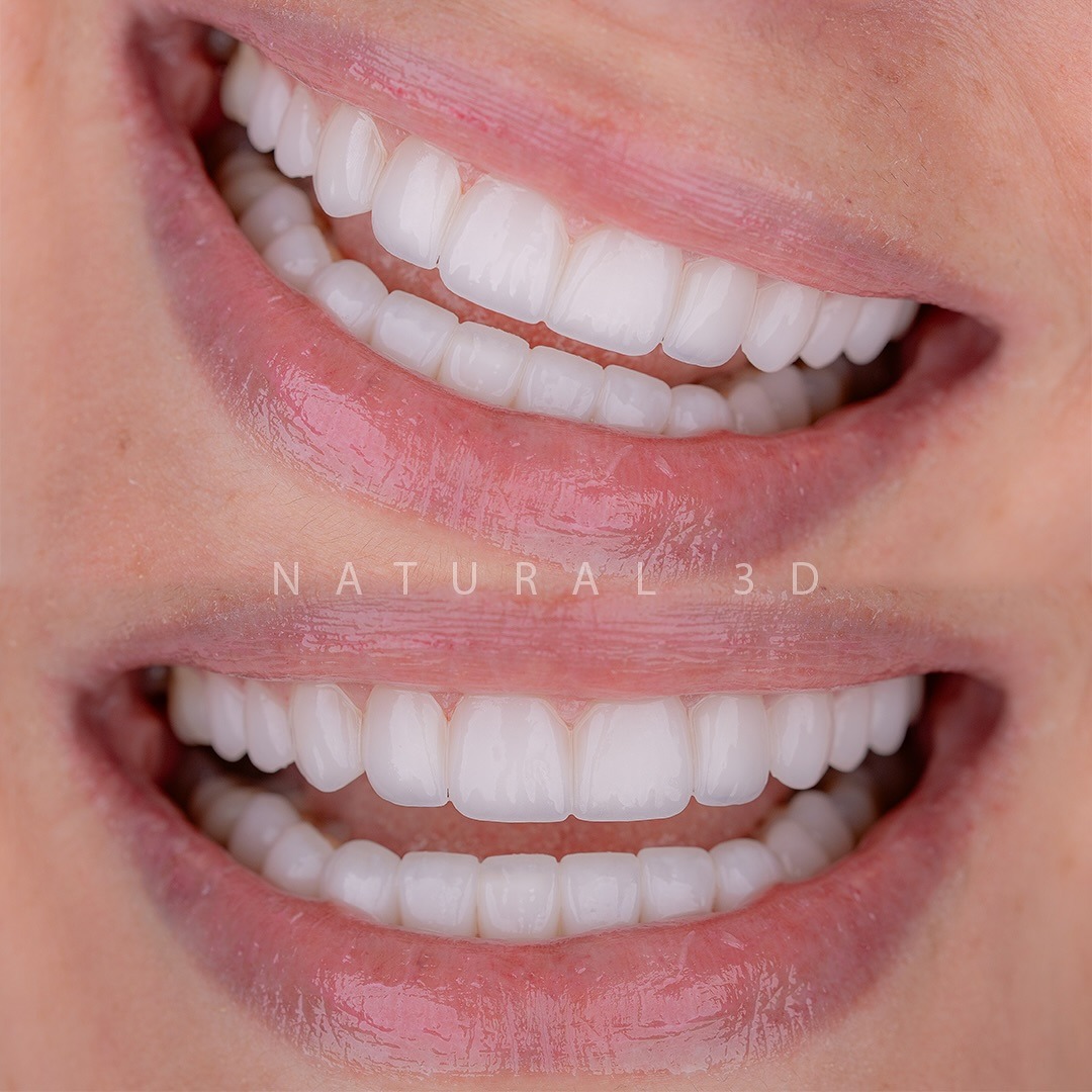 composite-veneers gallery 5