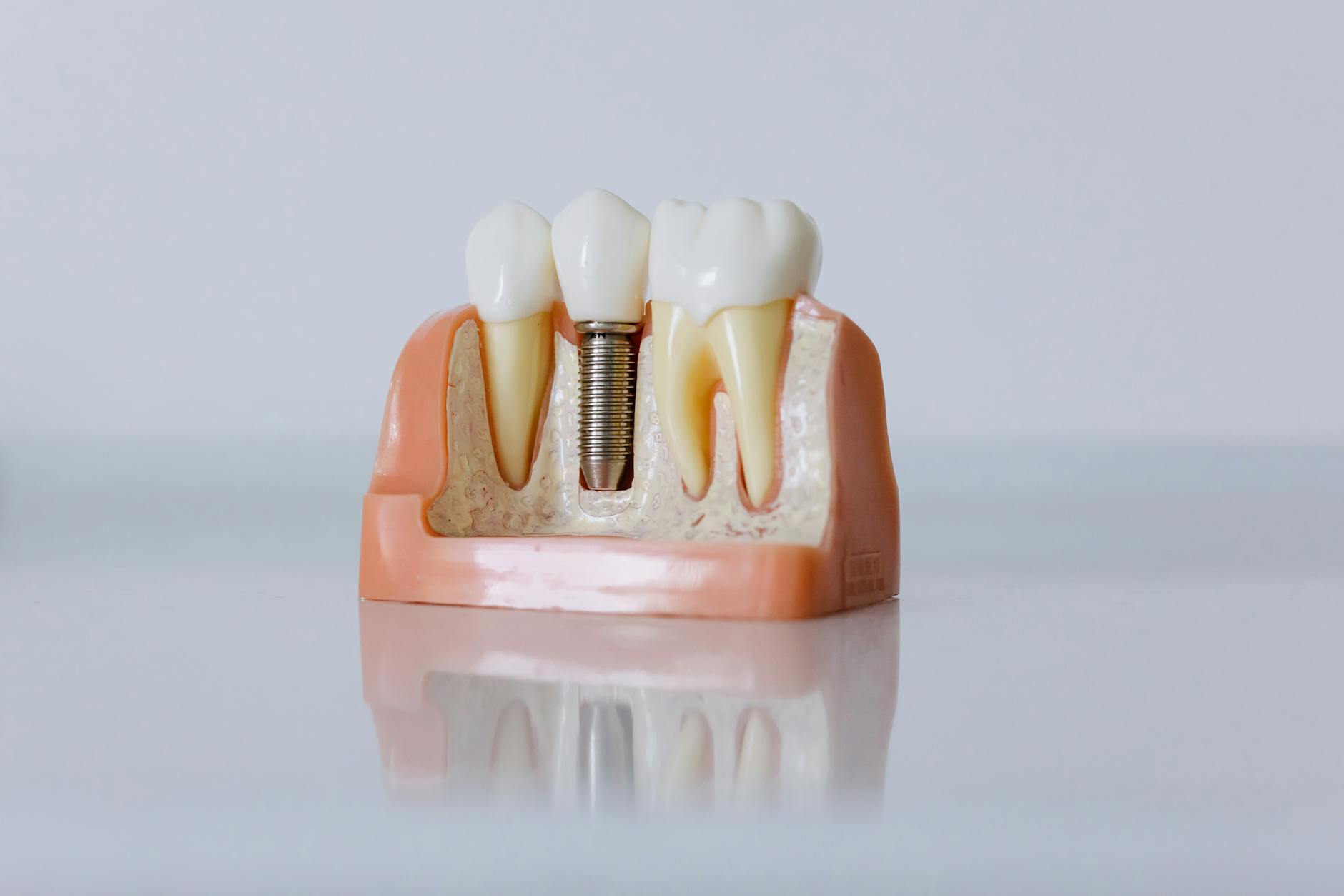 dental-implants gallery 2