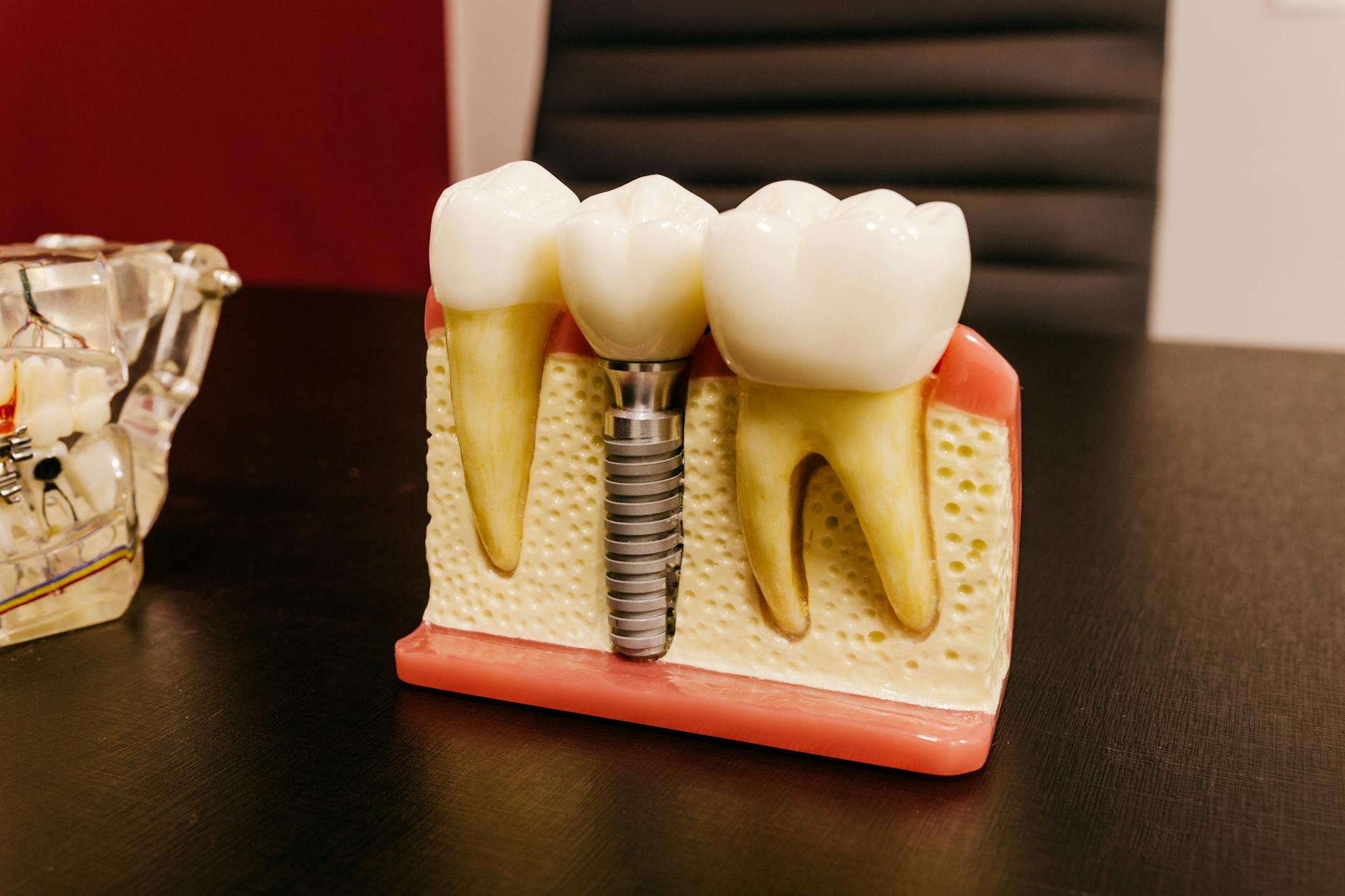 dental-implants gallery 3