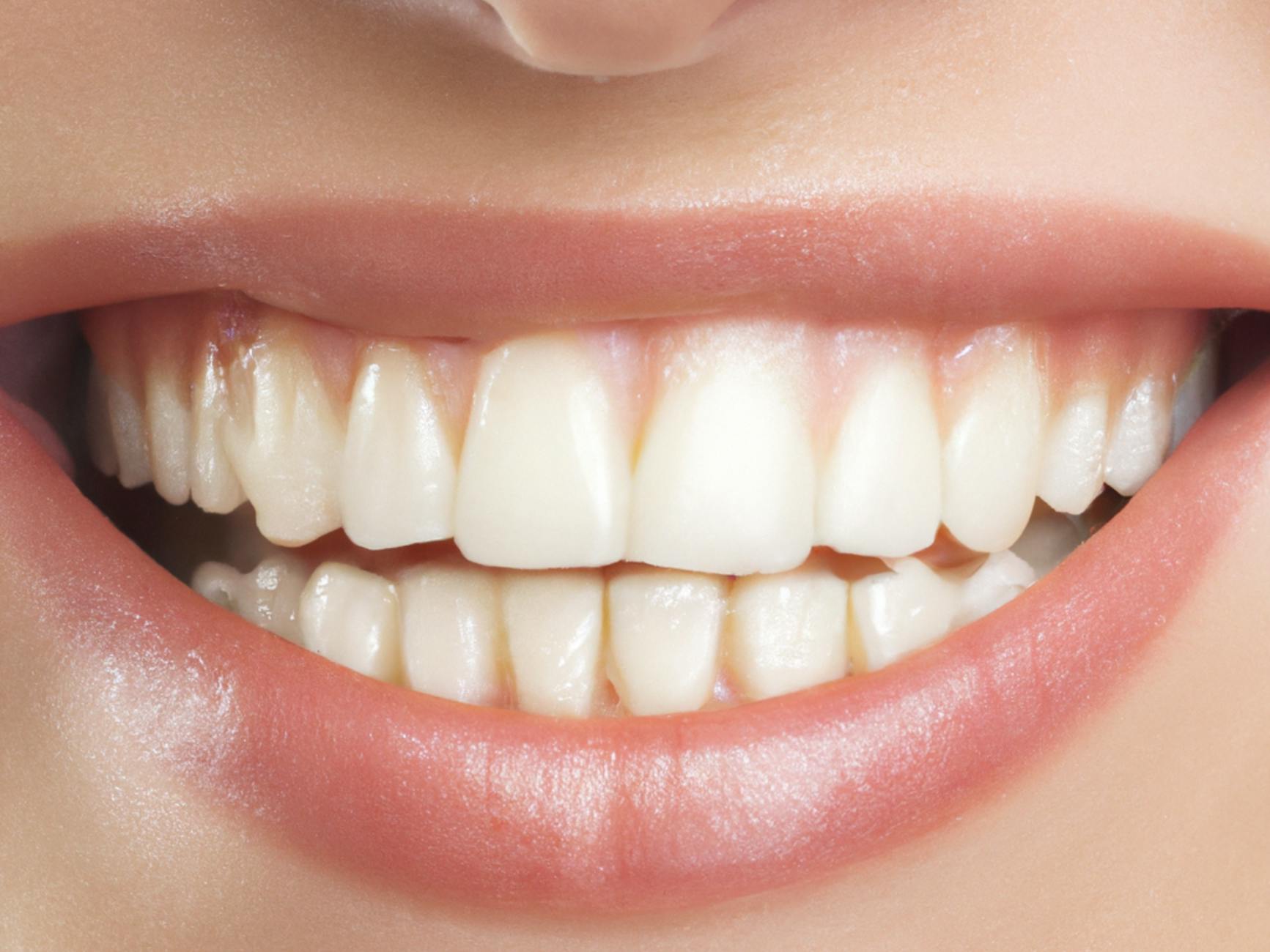 porcelain-veneers gallery 5
