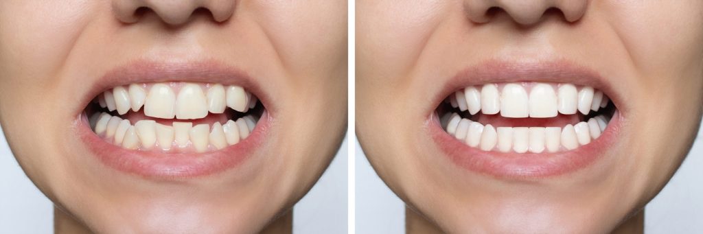 Professional teeth whitening at Smile Dental Center