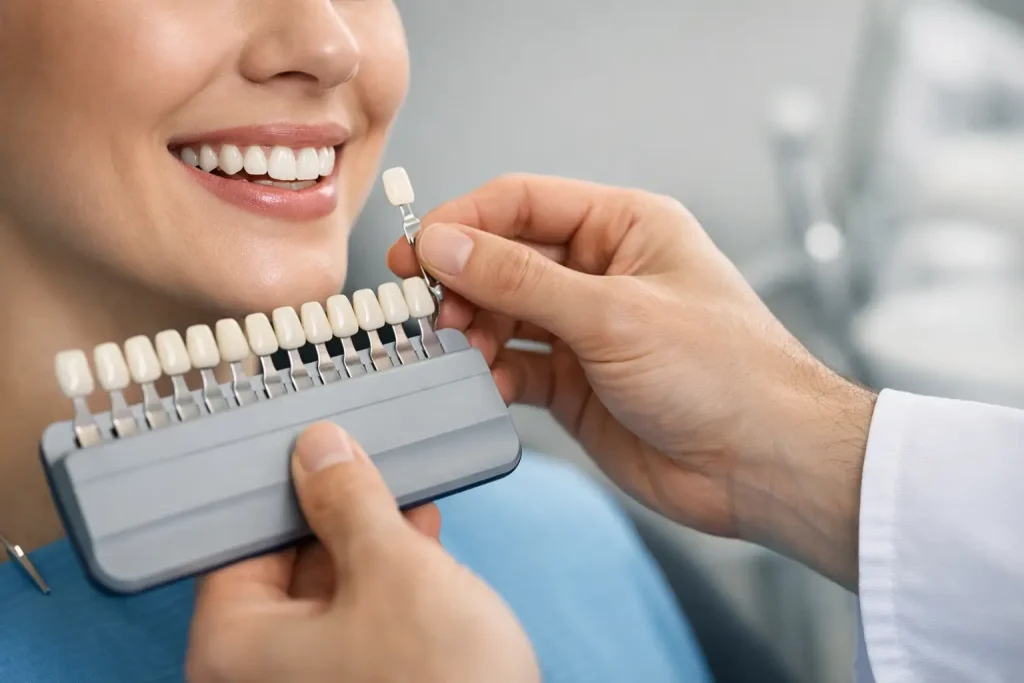 How Custom Veneer Shade Matching Works