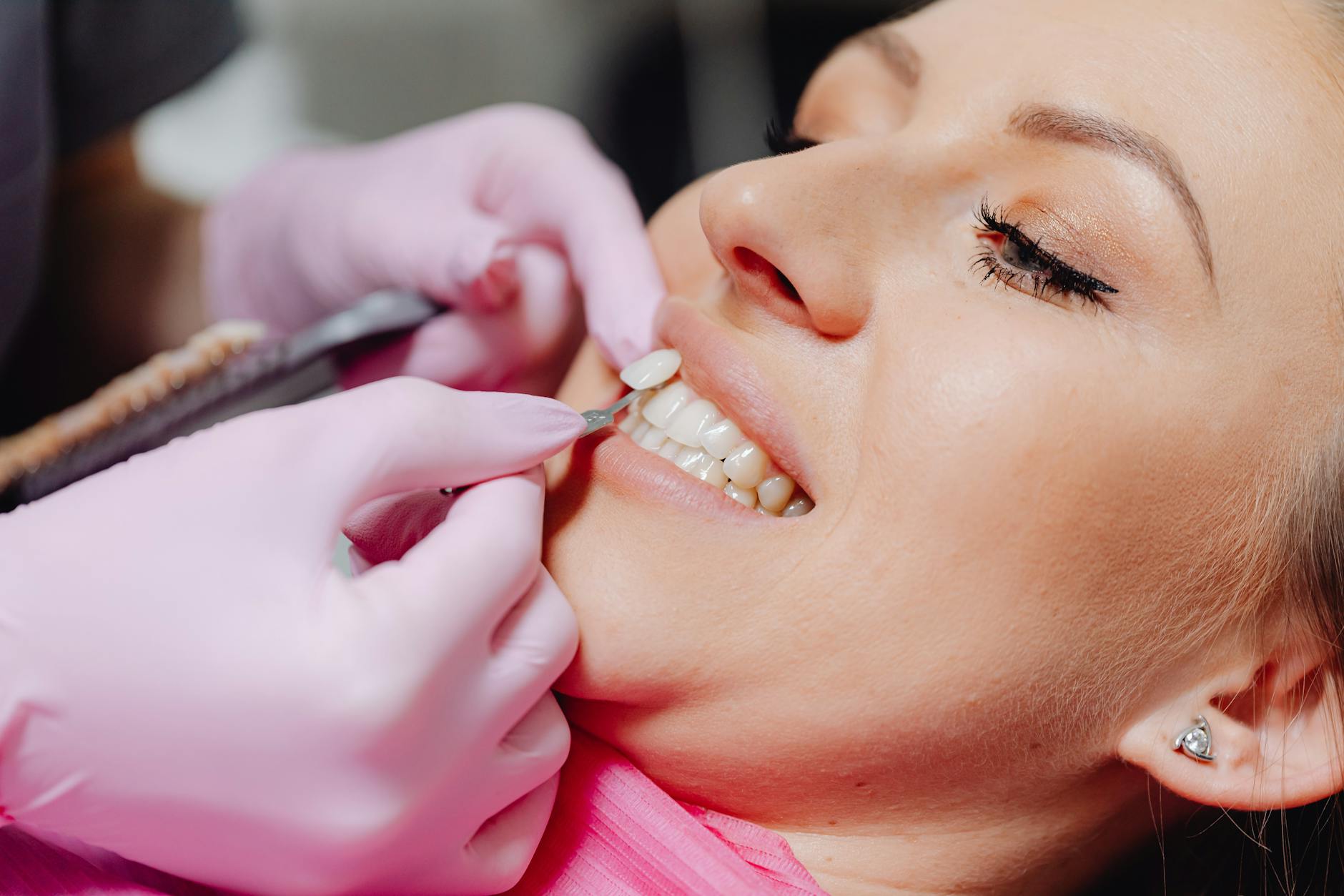 Dentist applying composite veneer to patient tooth in single appointment