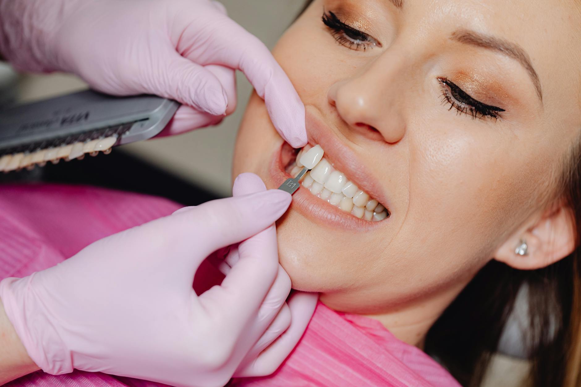 Before and after veneers payment plans in miami: how to finance your dream smile results