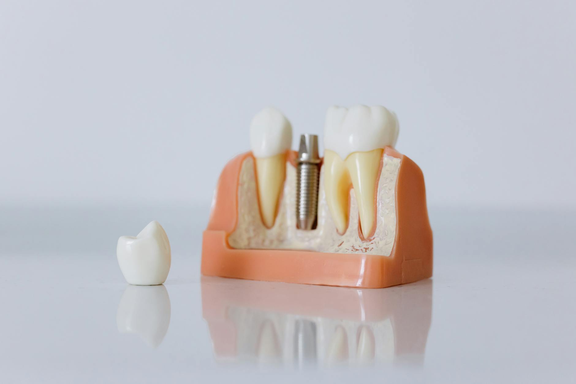 Before and after dental implants for seniors in miami: age is not a barrier results